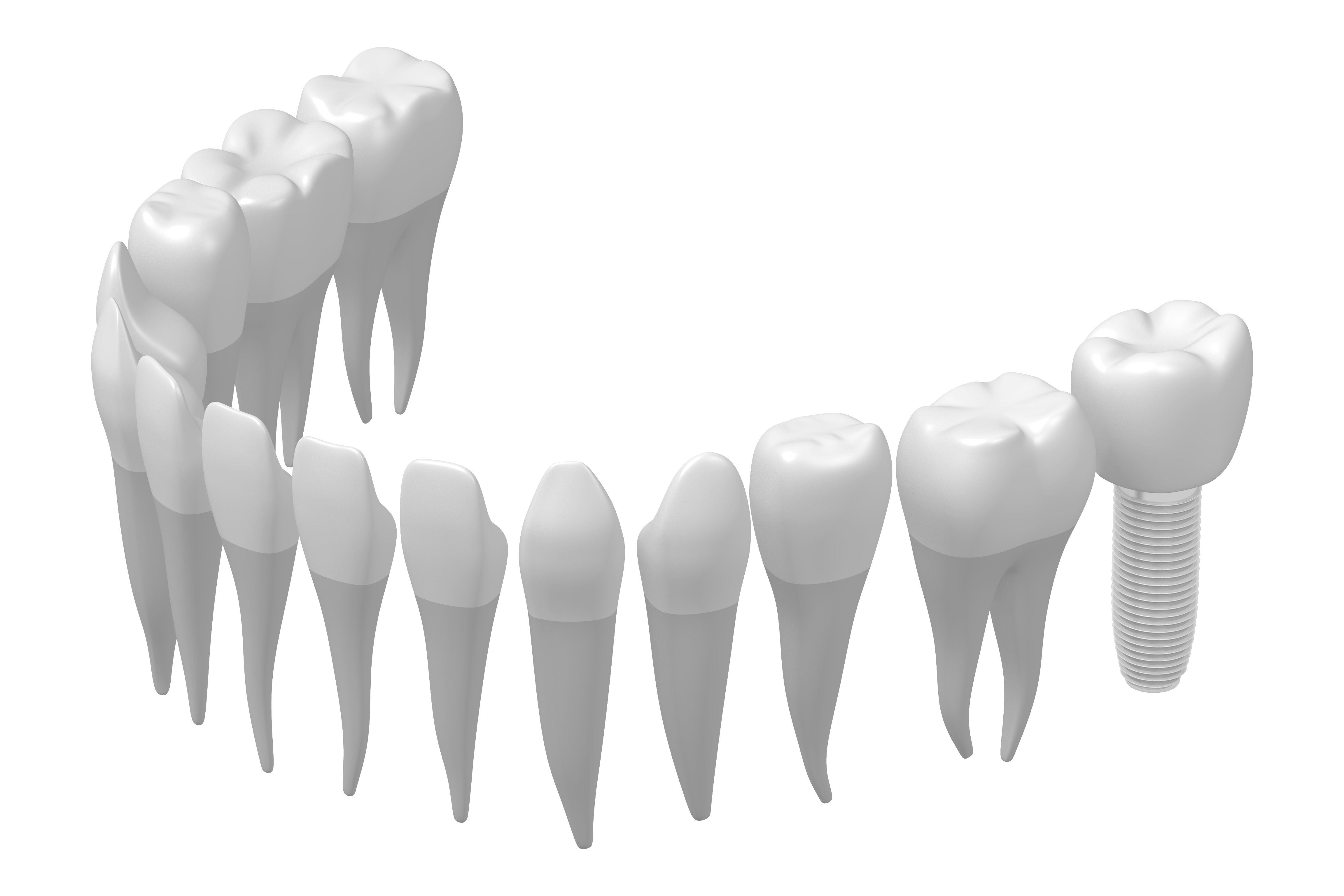 3D-Modell eines Zahnbogens mit Implantat als Zahnersatz