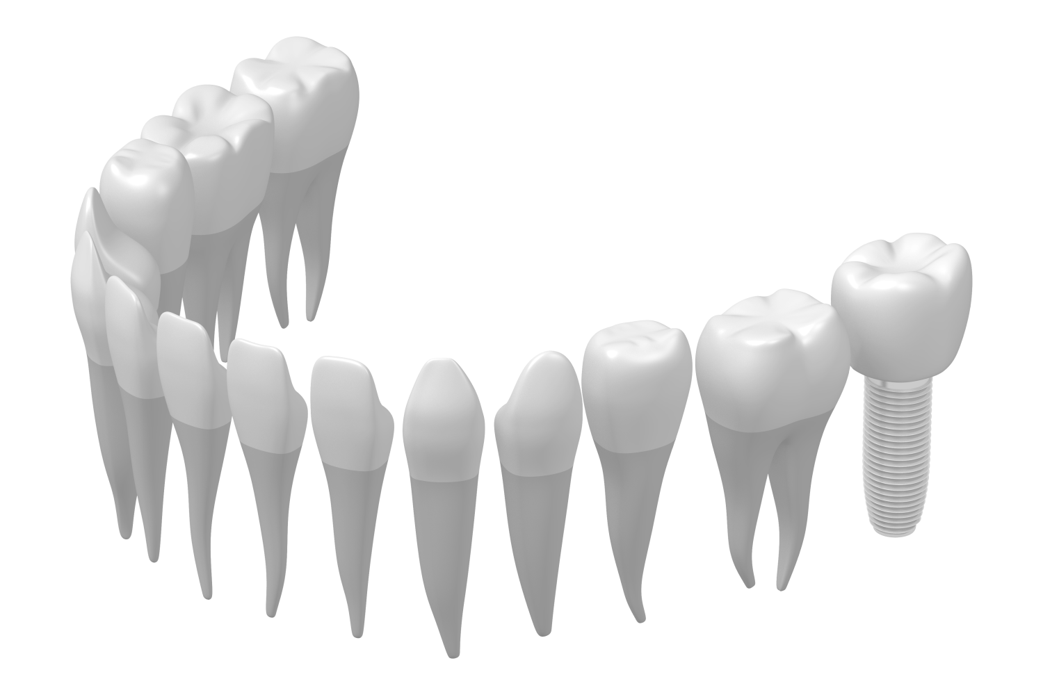 3D-Modell eines Zahnbogens mit Implantat als Zahnersatz